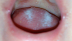 Milchablagerungen auf der Zunge